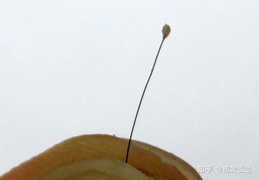 普拉朵植发丨毛发根部的小白点是毛囊吗