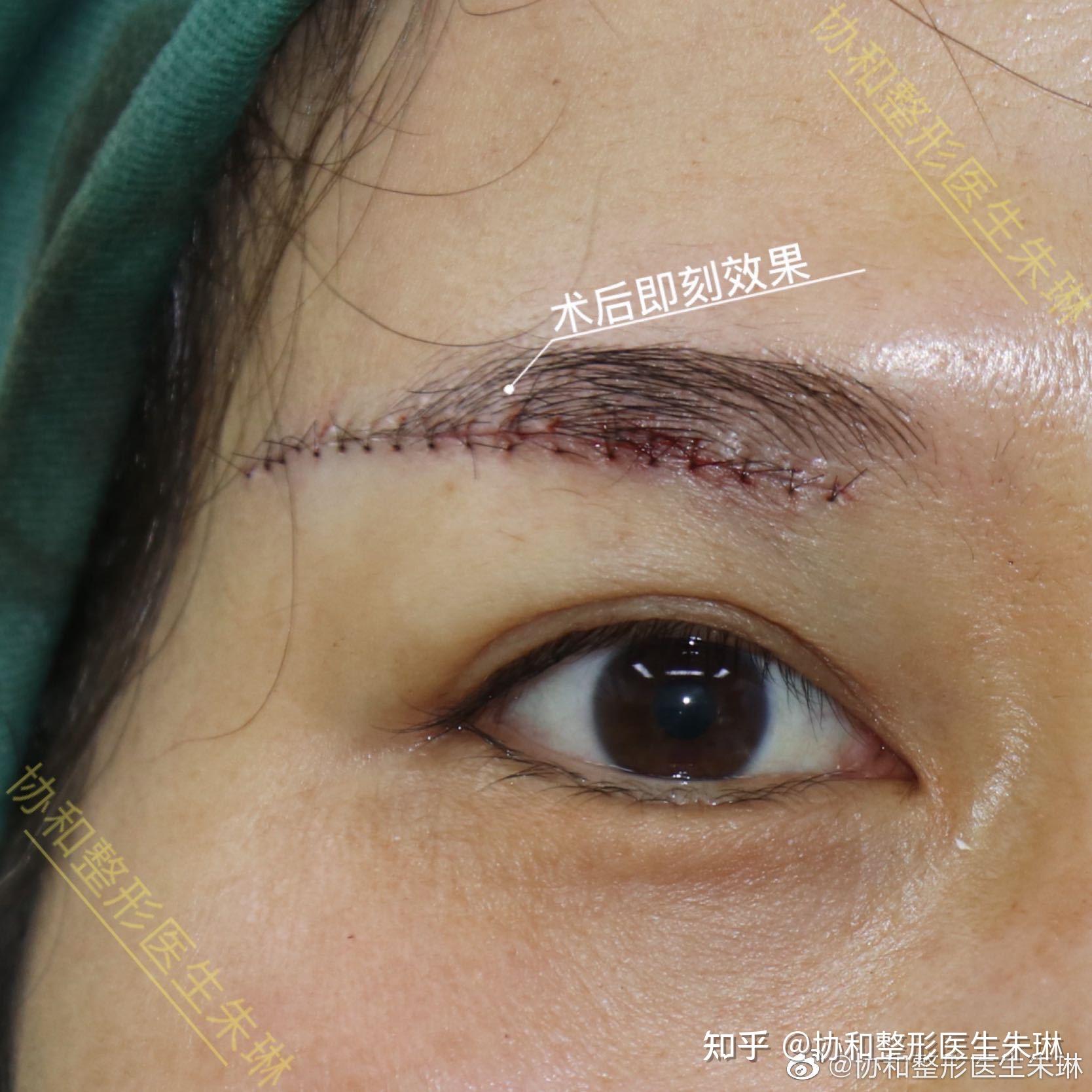 切眉手术过程图片
