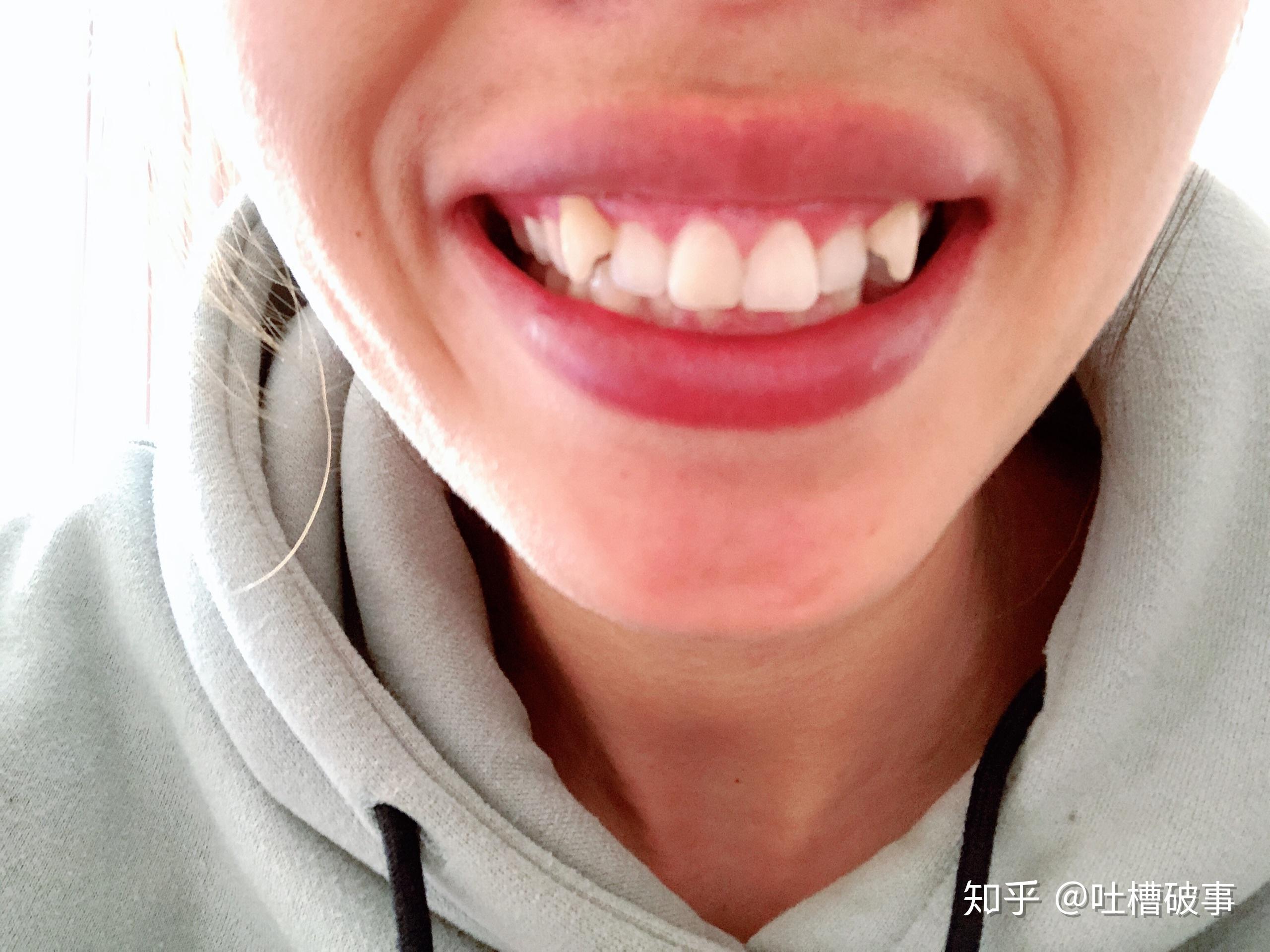 牙齿矫正|王俊凯为何要矫正他的“萌虎牙”？