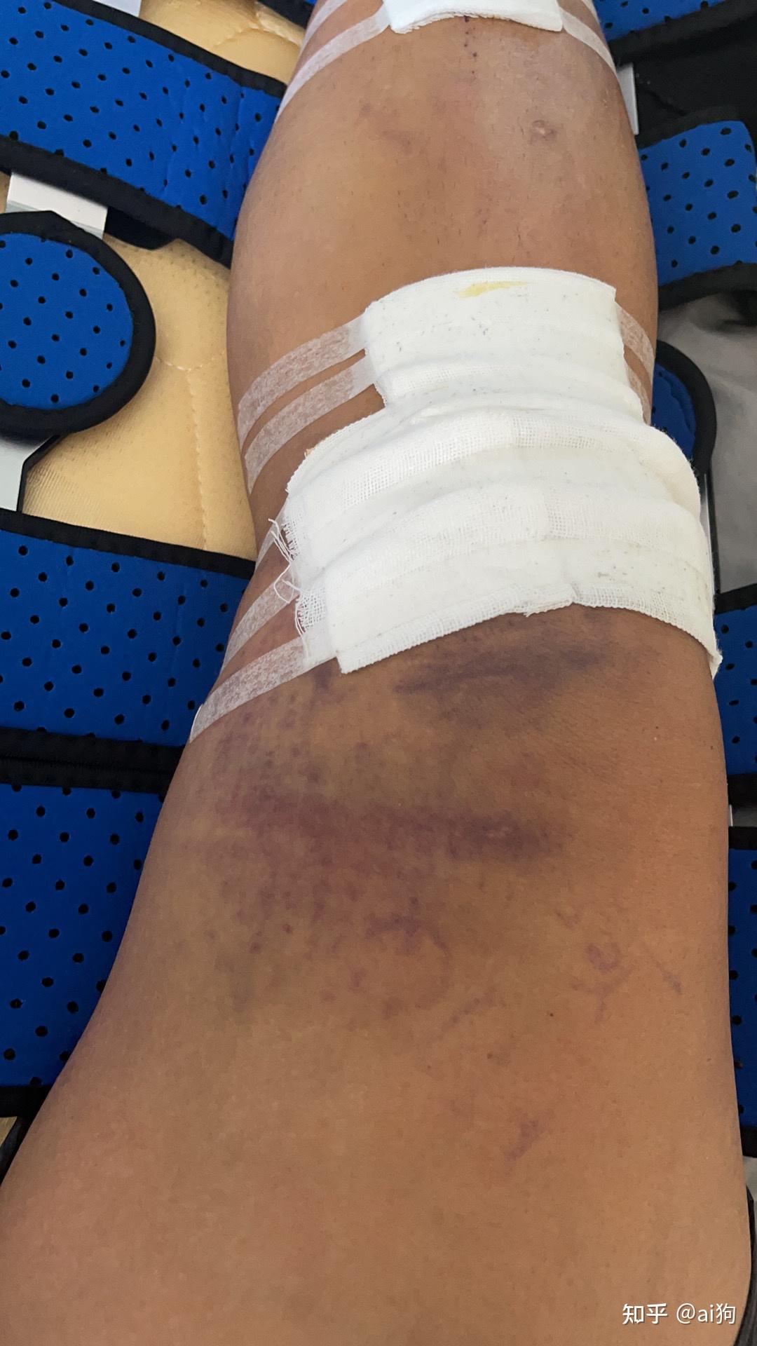 我的膝盖又伤了康复之路3