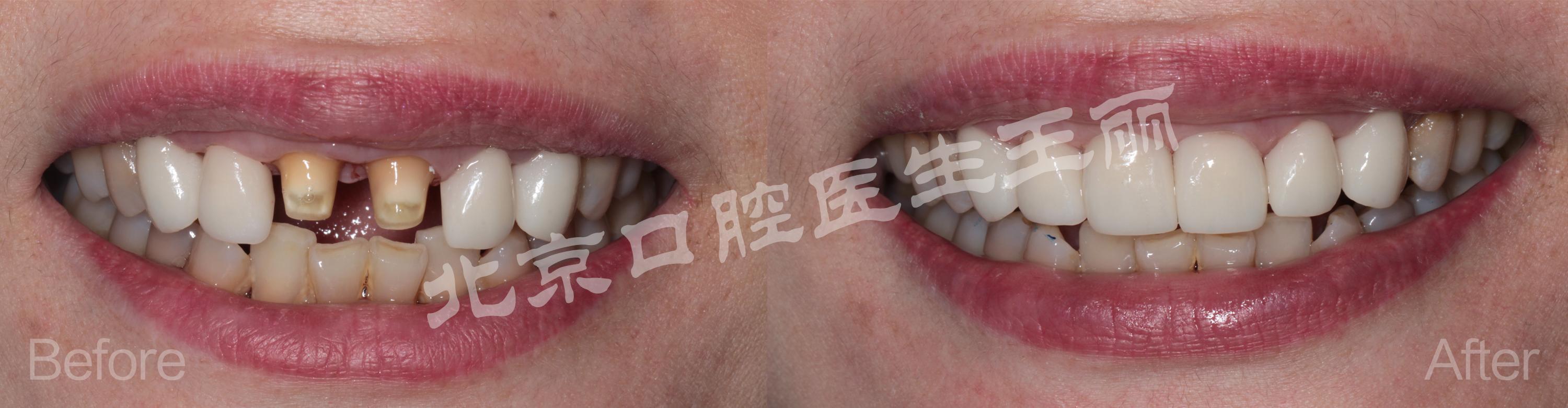补牙&洗牙注意事项&价格…去过上海多家医院经验分享 - 知乎