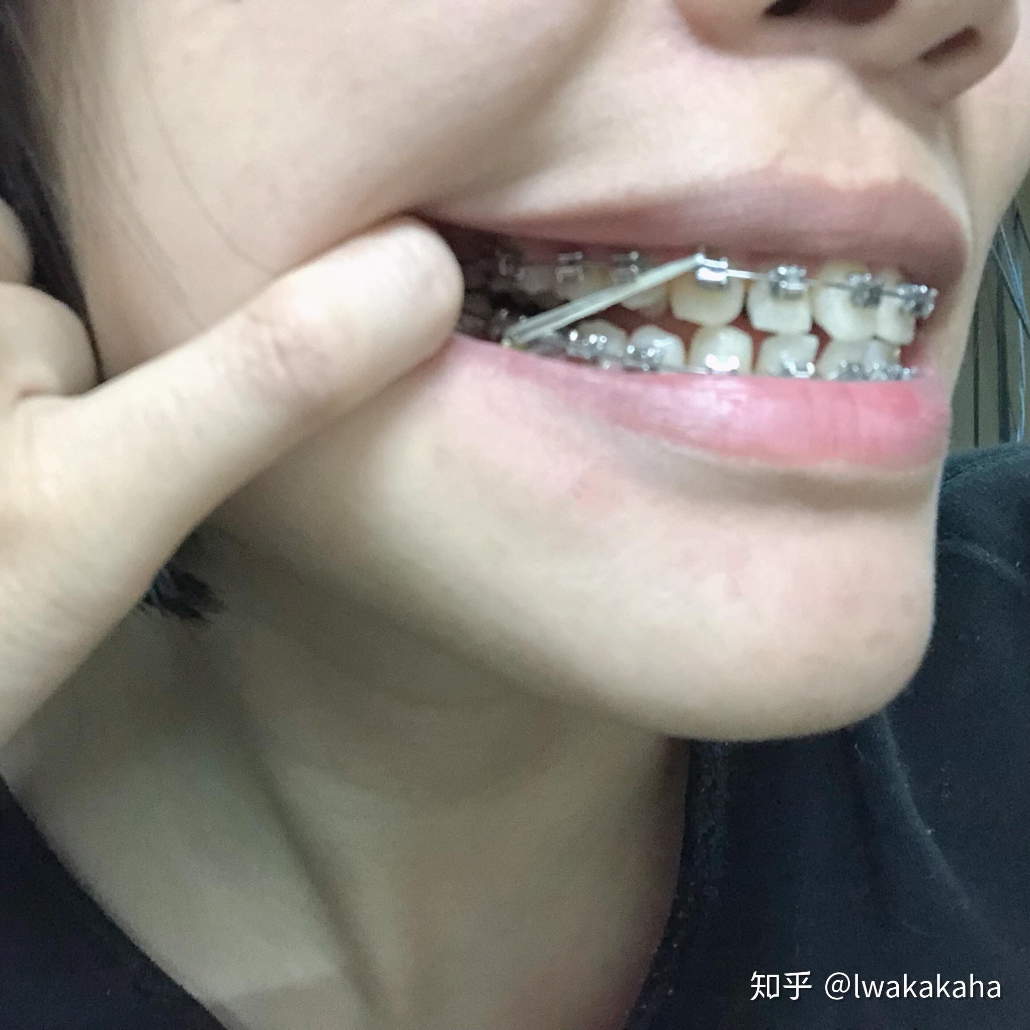 来说说牙齿矫正挂小皮筋是什么感受? - 知乎