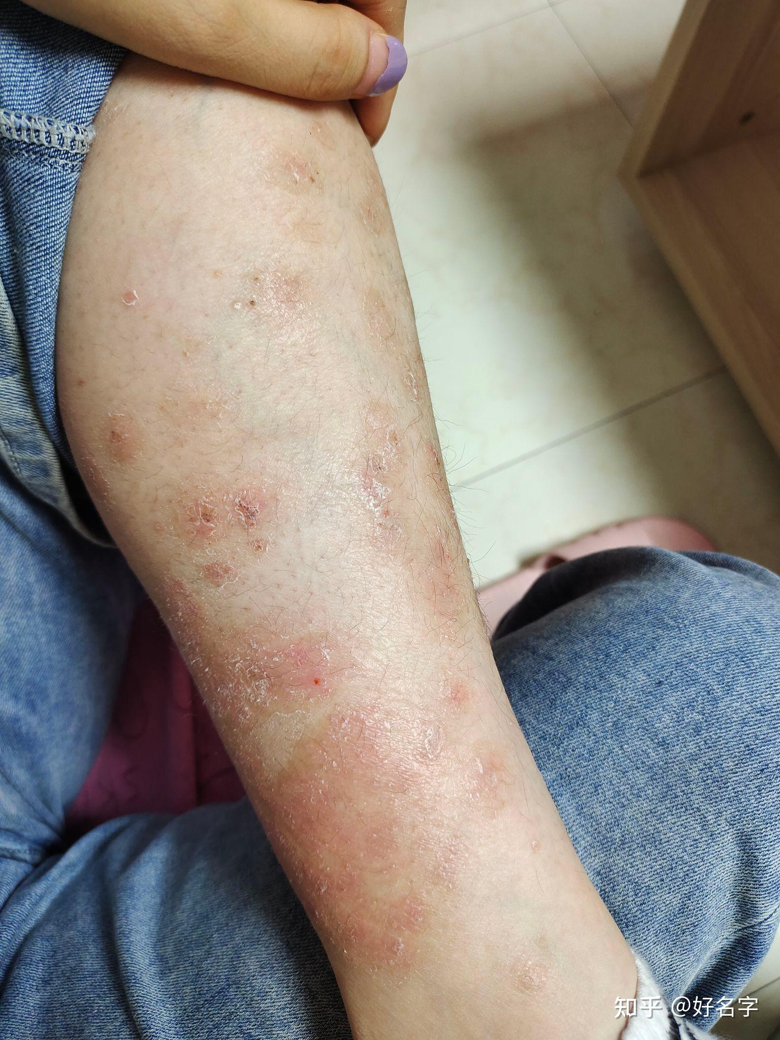 13银屑病 生物制剂可善挺日常记录 希望给病友一些参考吧