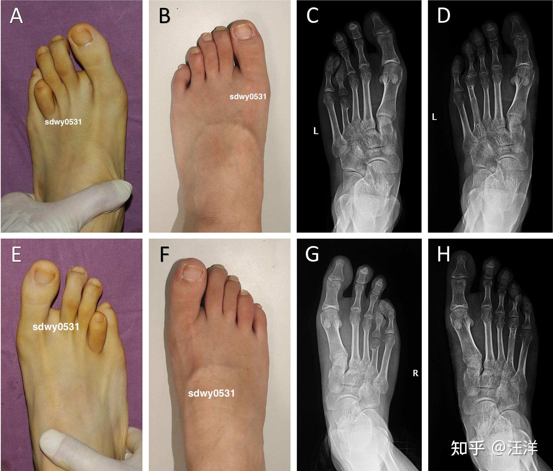 该和双脚患有第四跖骨短小症的女友继续交往吗? - 知乎