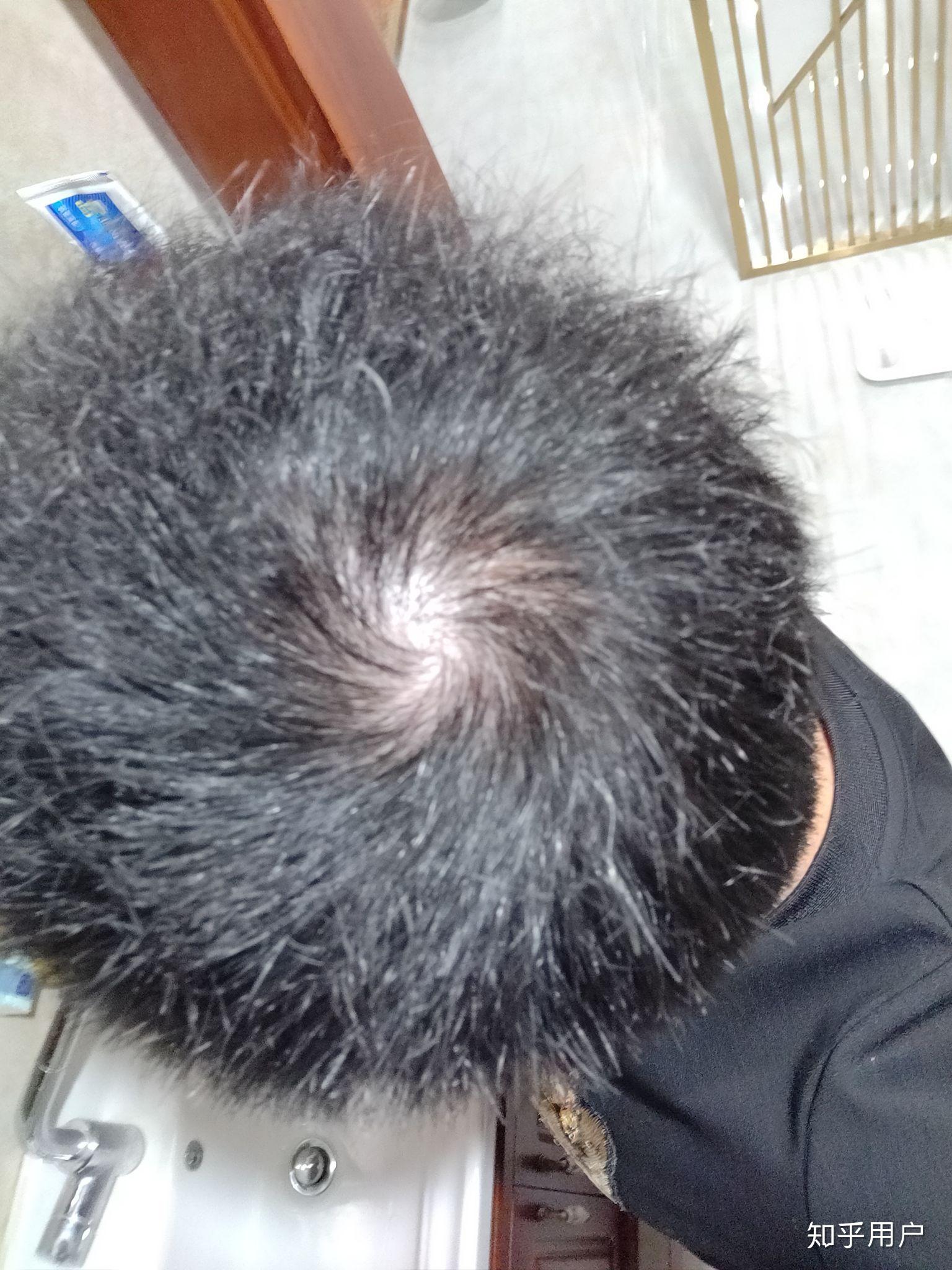头顶漩涡处头发少,会不会秃顶? - 知乎