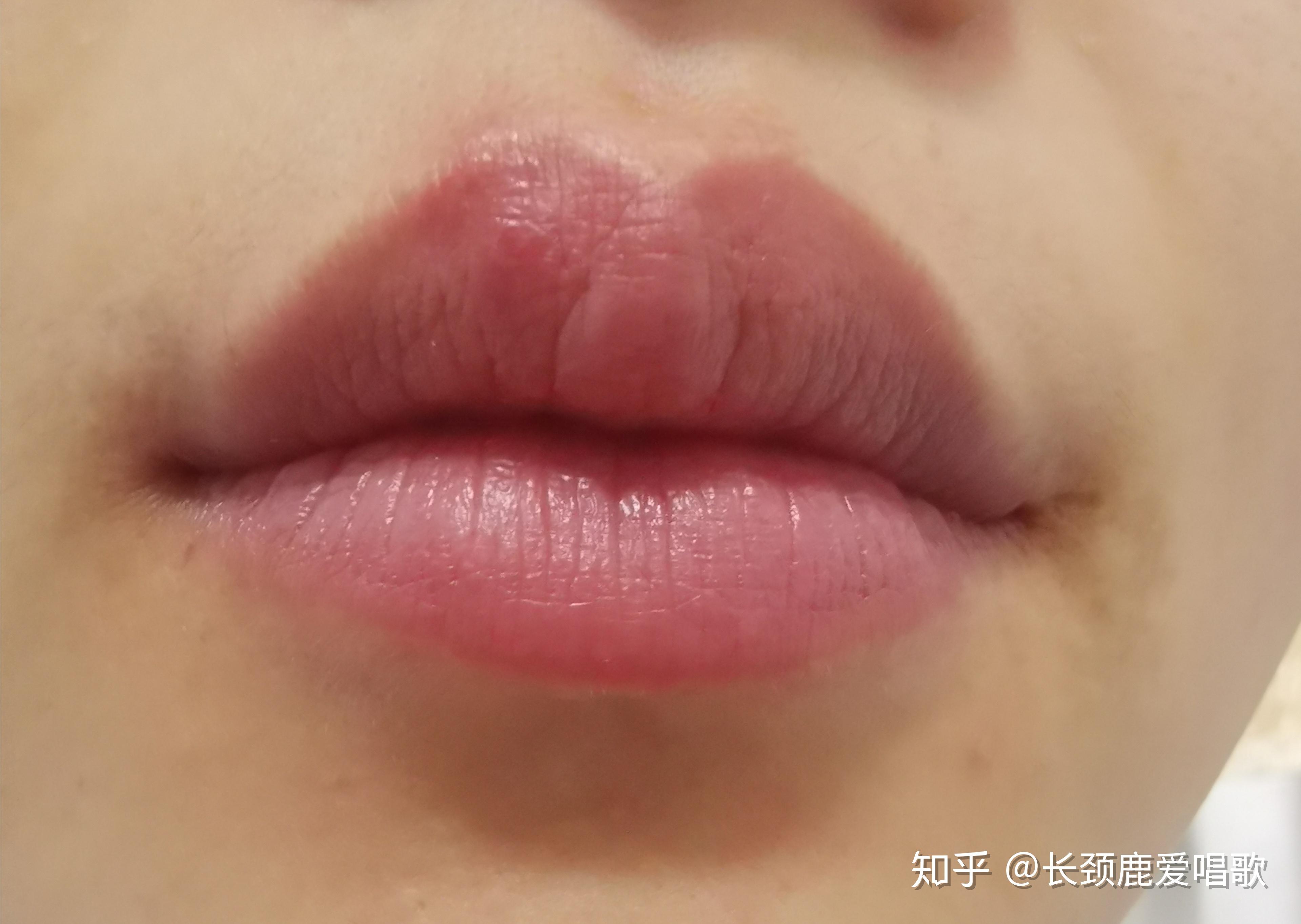 口唇疱疹怎么能快速好啊?急~? - 知乎