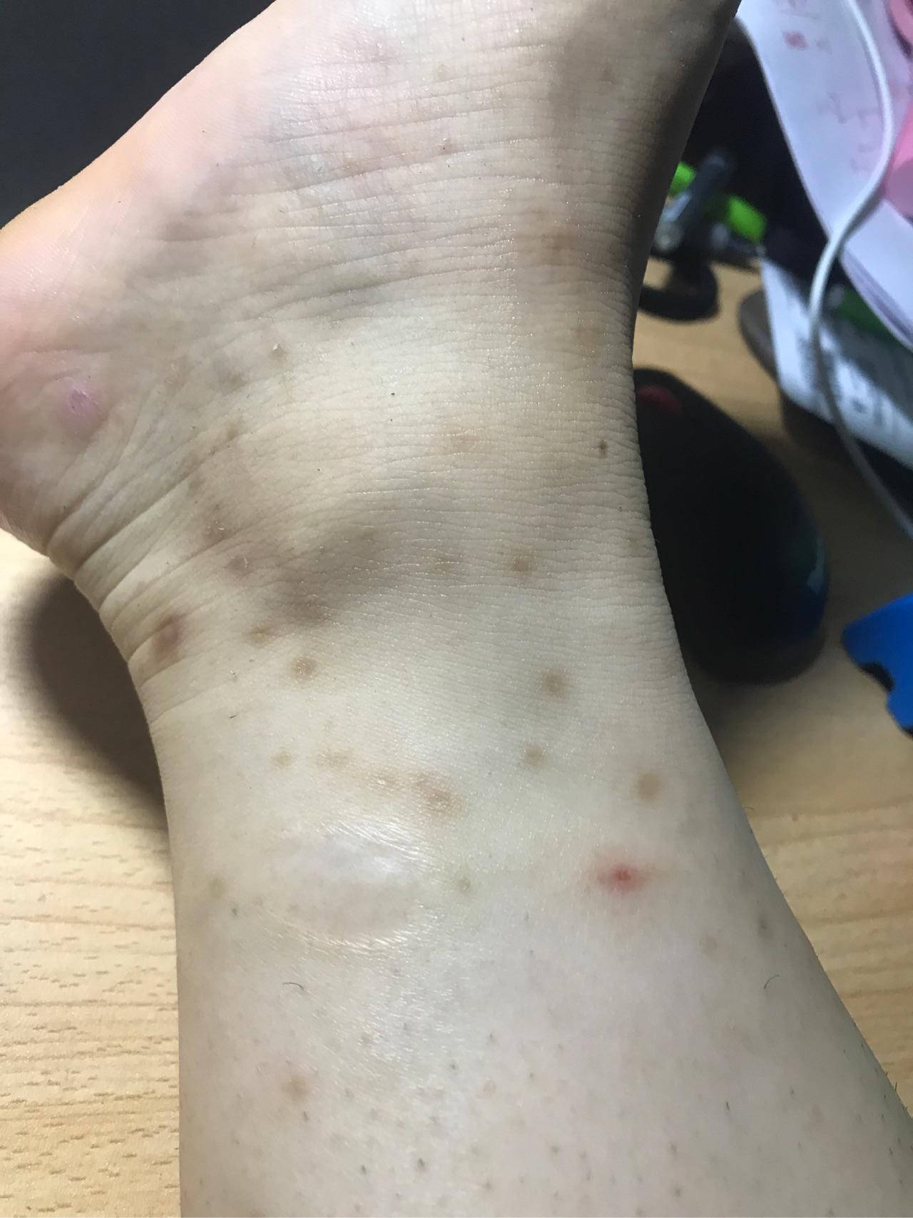被蚊子咬了留下的疤怎么去除？ - 知乎