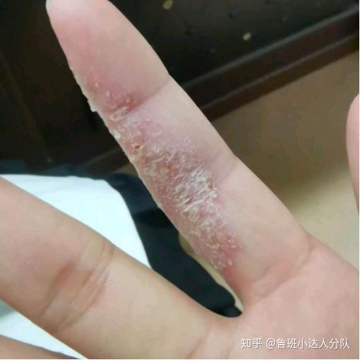 如何区分手指皮肤开裂是真菌还是湿疹?