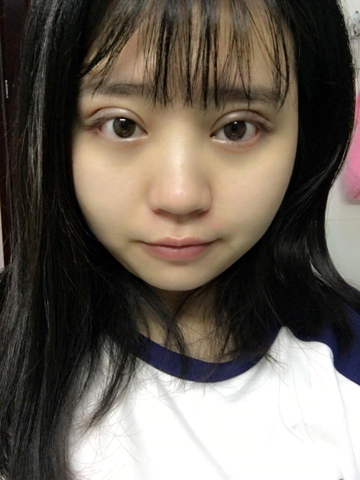 纳米无痕埋线双眼皮恢复记录