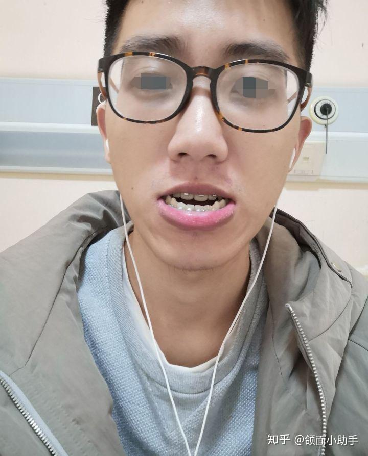 做正颌手术危险吗