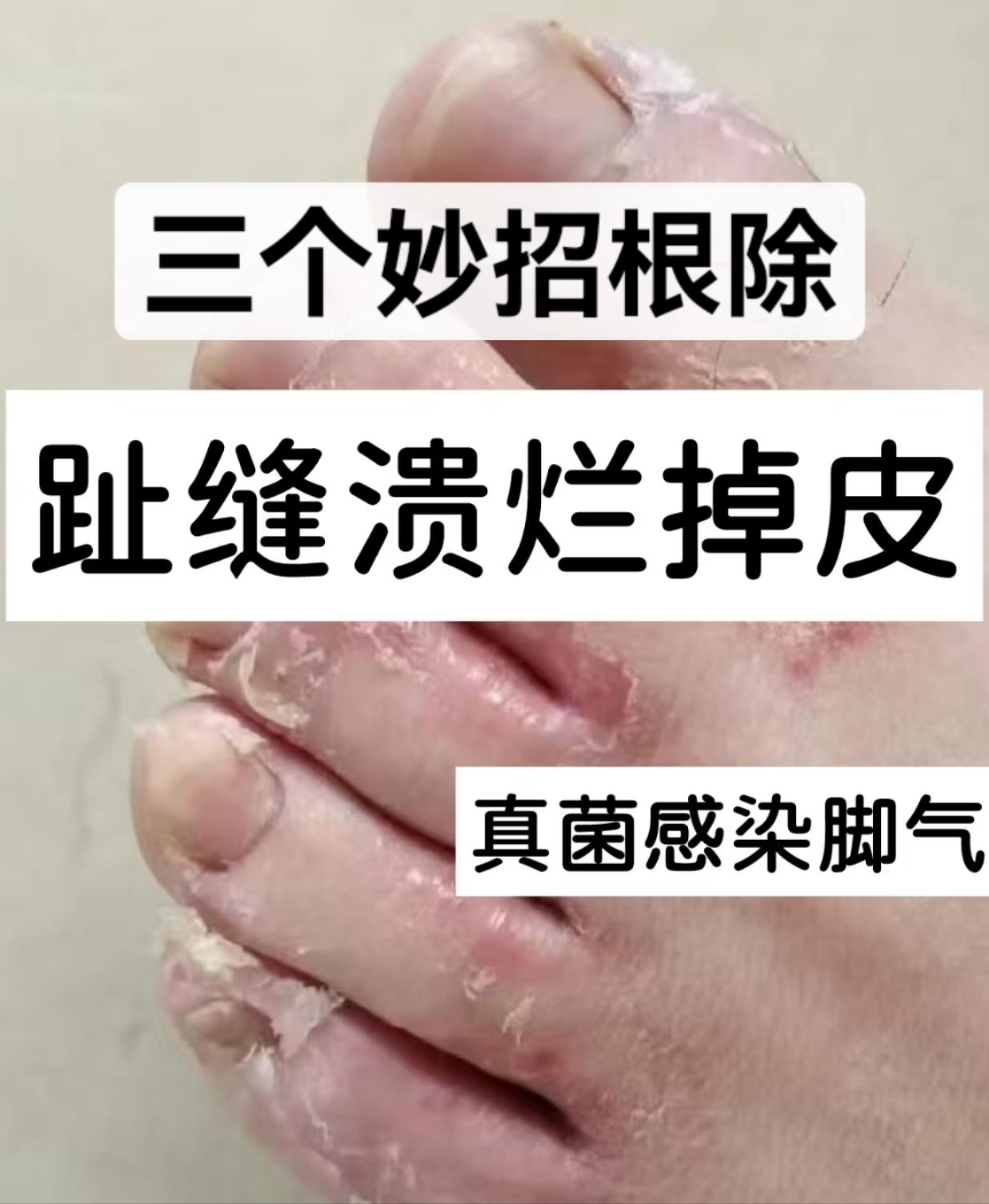 三个小妙招治愈脚趾缝溃烂脱皮痒赶紧收藏