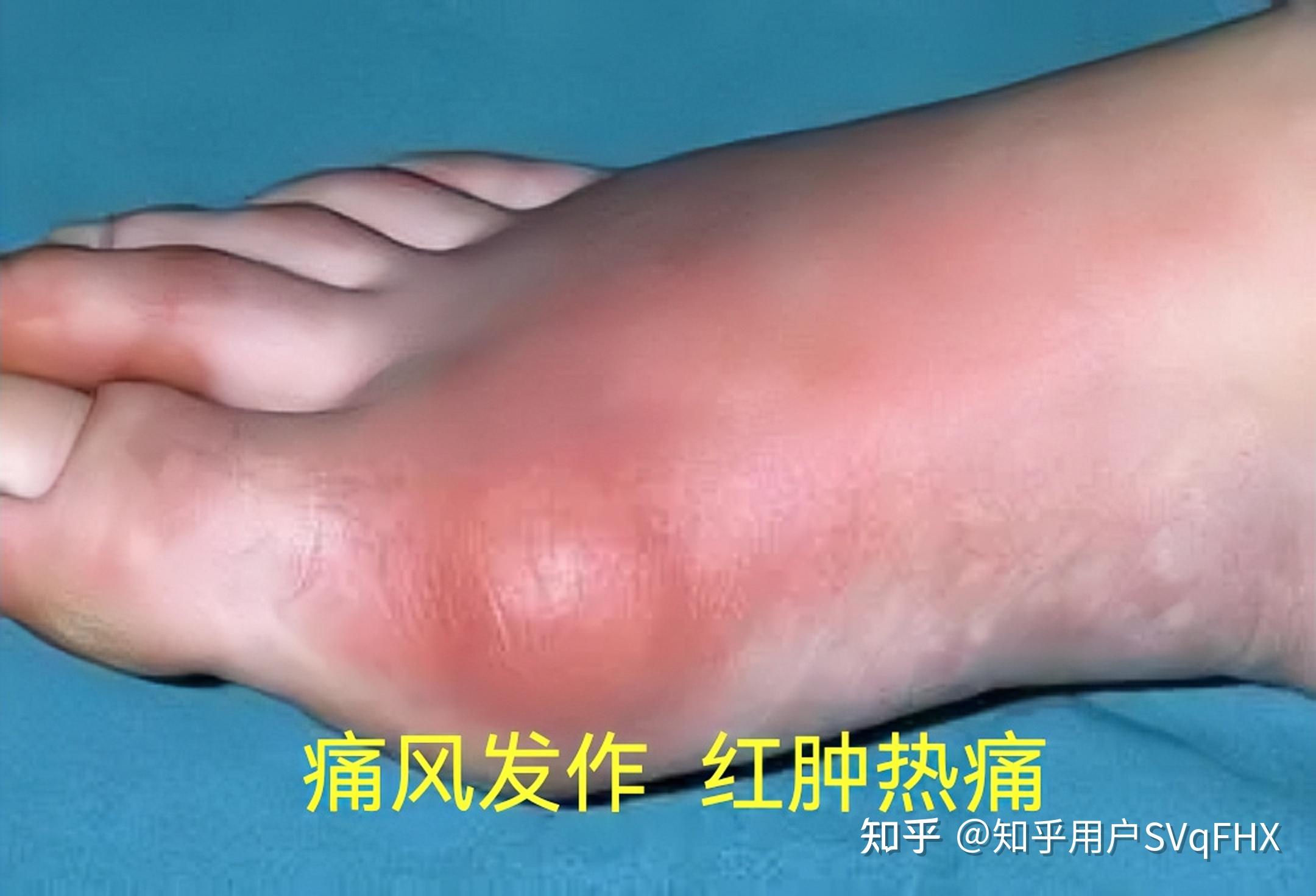此时临证可以用四妙散为基础方加味治疗,常可获得良好疗效.