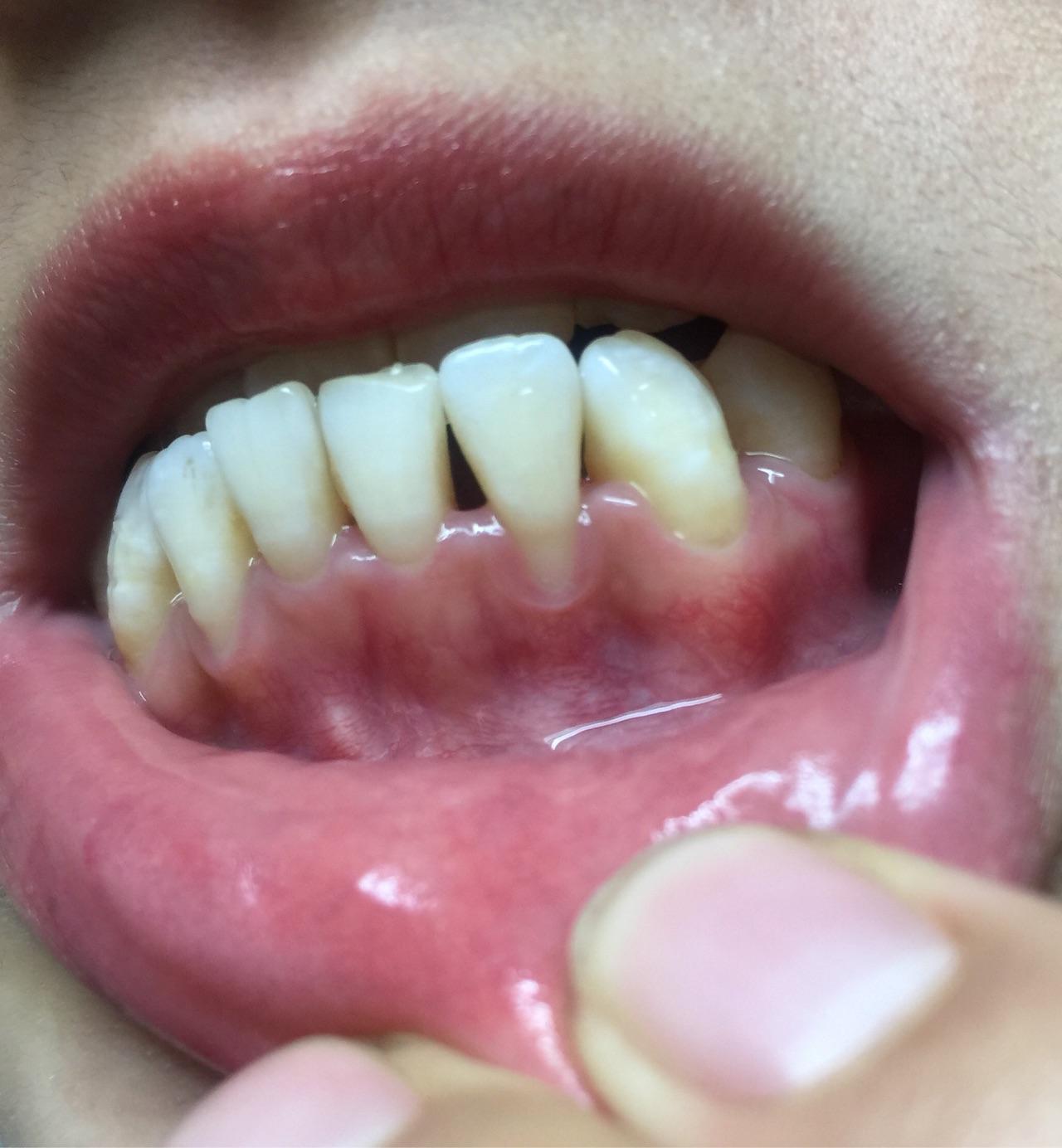 婴儿牙龈上有小白点（牙龈上有小白点是不是病）-幼儿百科-魔术铺