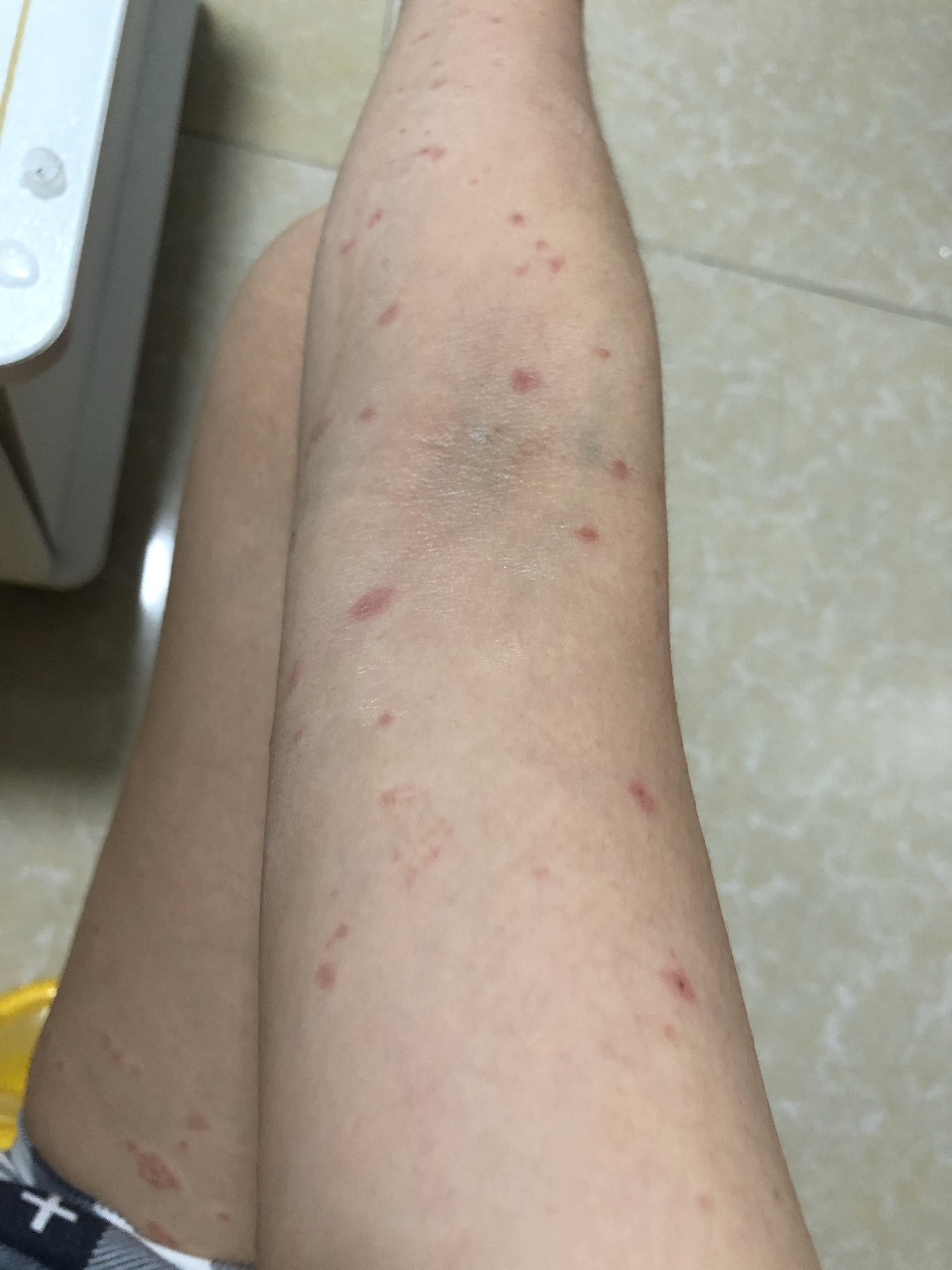 皮肤病玫瑰糠疹转湿疹有办法