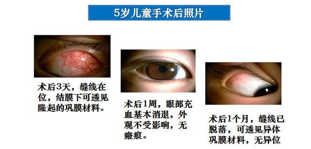 当心这种疾病已成为全球第二大致盲原因