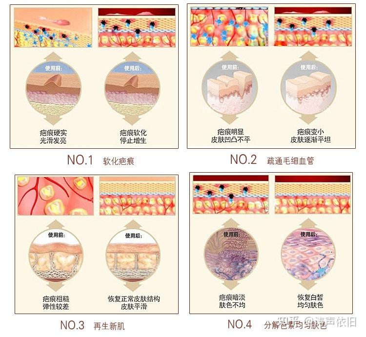 号称去疤神器的“淮沐净冷敷凝胶”好用吗?|疤痕|增生|痘坑|伤刀疤|妊娠疤 - 知乎