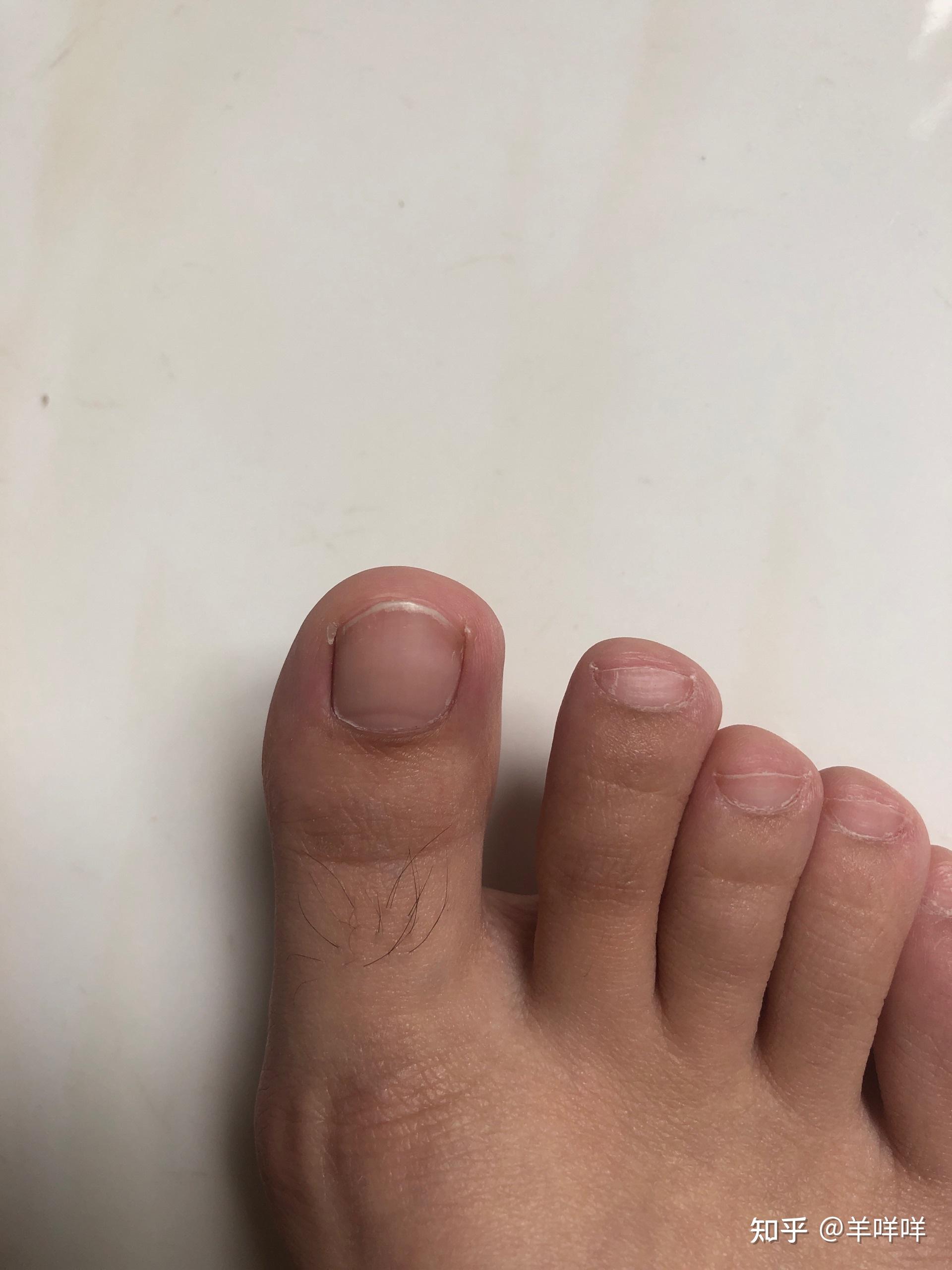 甲分离型灰指甲治愈过程