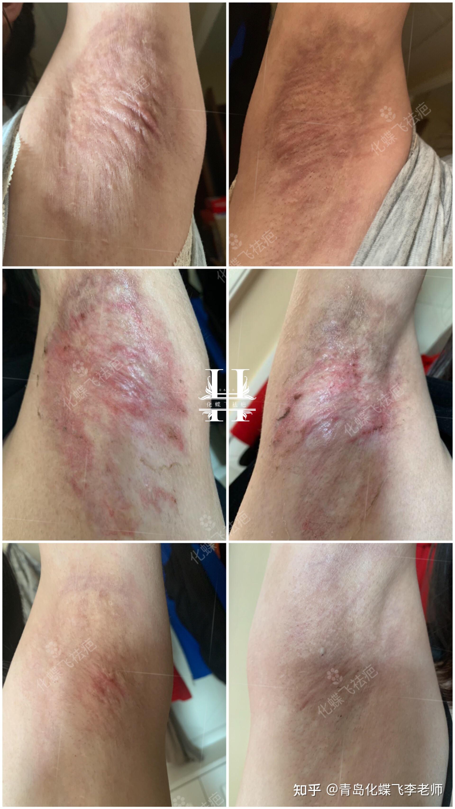 成都去腋下疤痕那好