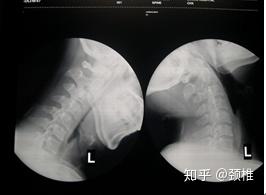 一个颈椎病锻炼康复患者对颈椎病知识的整理及