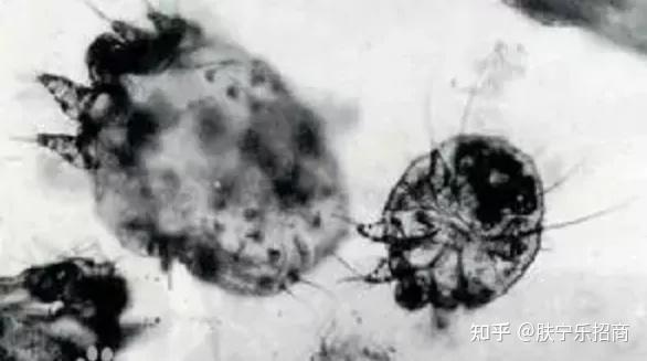 教你走出误区——疥疮小科普 - 知乎