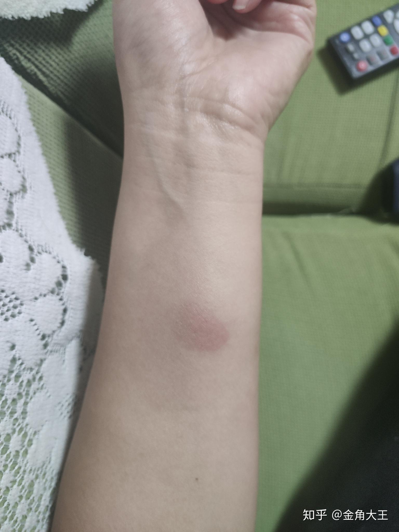 ppd皮试后这个样子怎么办? - 知乎