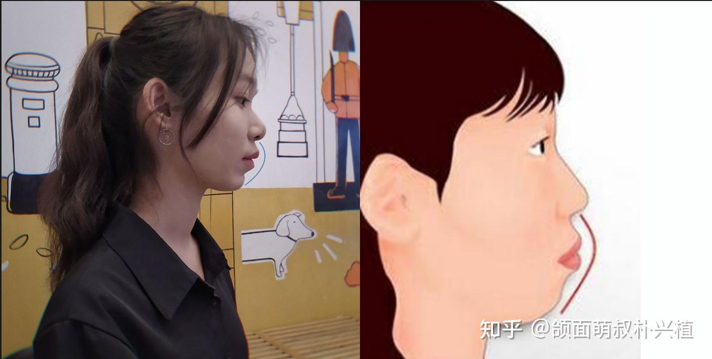 唇性凸嘴怎么办呢