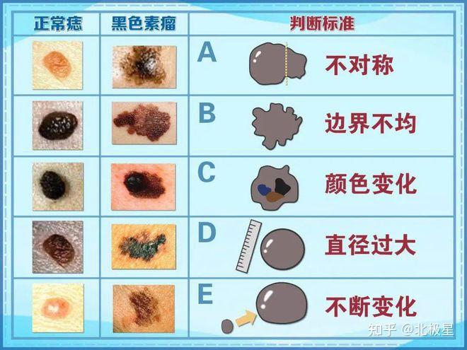 如何区分黑色素痣和普通痣? - 知乎