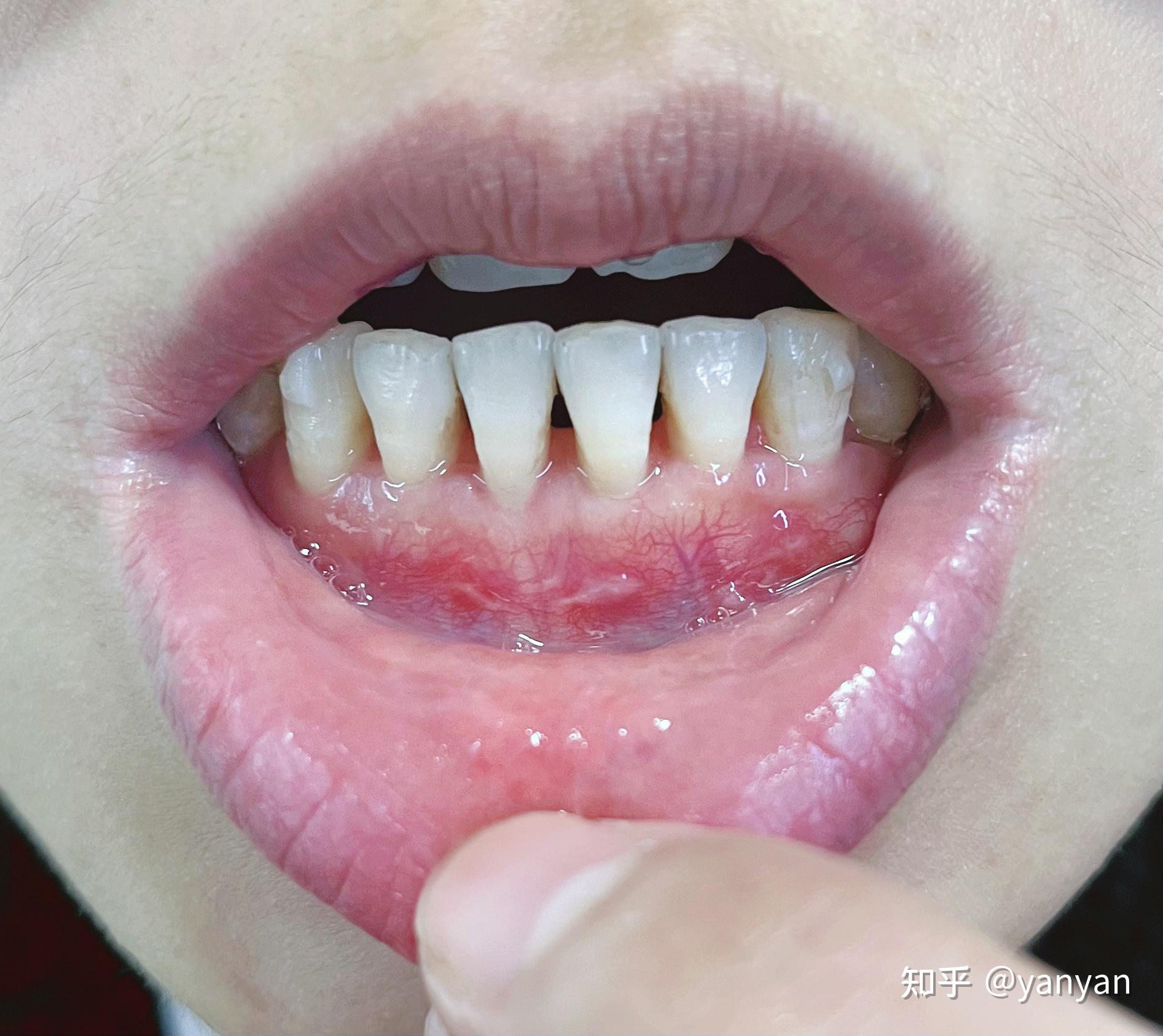 造成牙龈萎缩的原因有哪些？ - 知乎