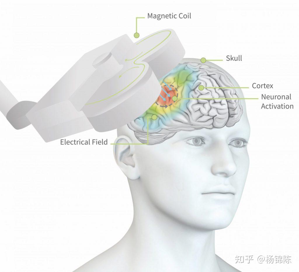 【E课堂】（上篇）经颅磁刺激在脑卒中后运动及语言功能康复中的临床应用