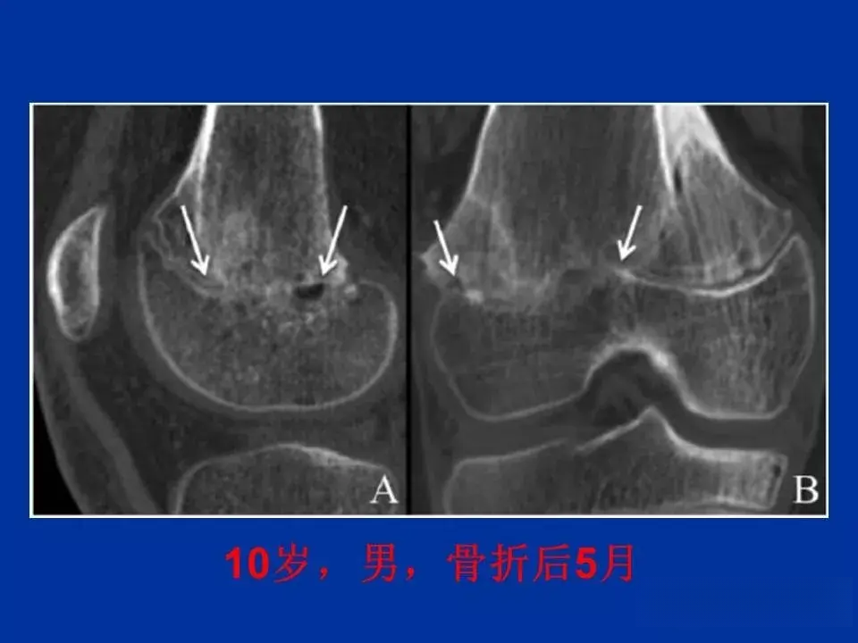 骨骺软骨损伤MR高清影像诊断图文详解 - 知乎