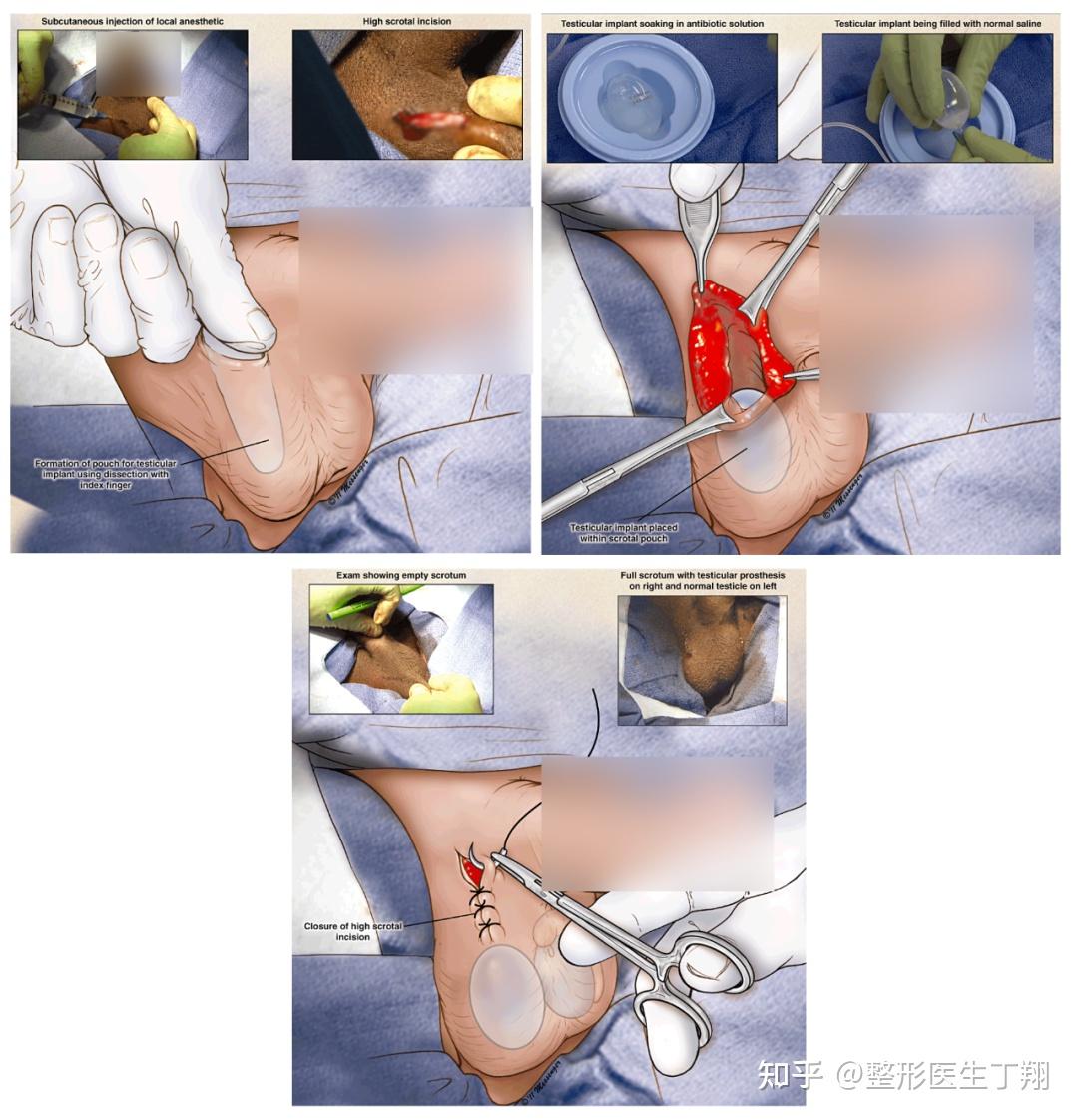 男性植入假体手术图片