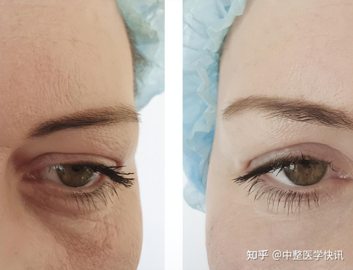 郭鑫医生眼袋手术案例二：外切眼袋去除术（下眼睑除皱）_拆线