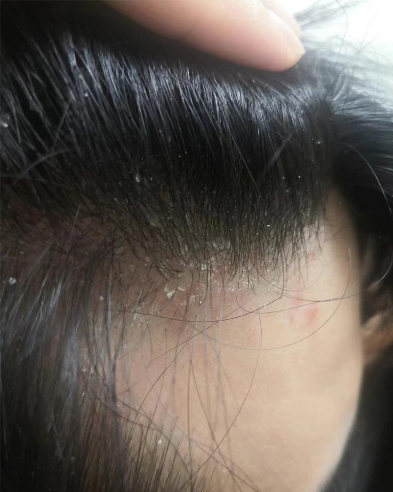 针对头皮屑问题,我们精心整理了一份男士去头屑最好的洗发水排行榜