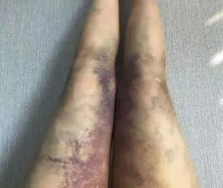 网红小冉因抽脂感染去世#迈尔密呼吁:极端减肥适可而止