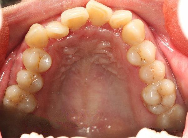 牙列不齐的危害有多大