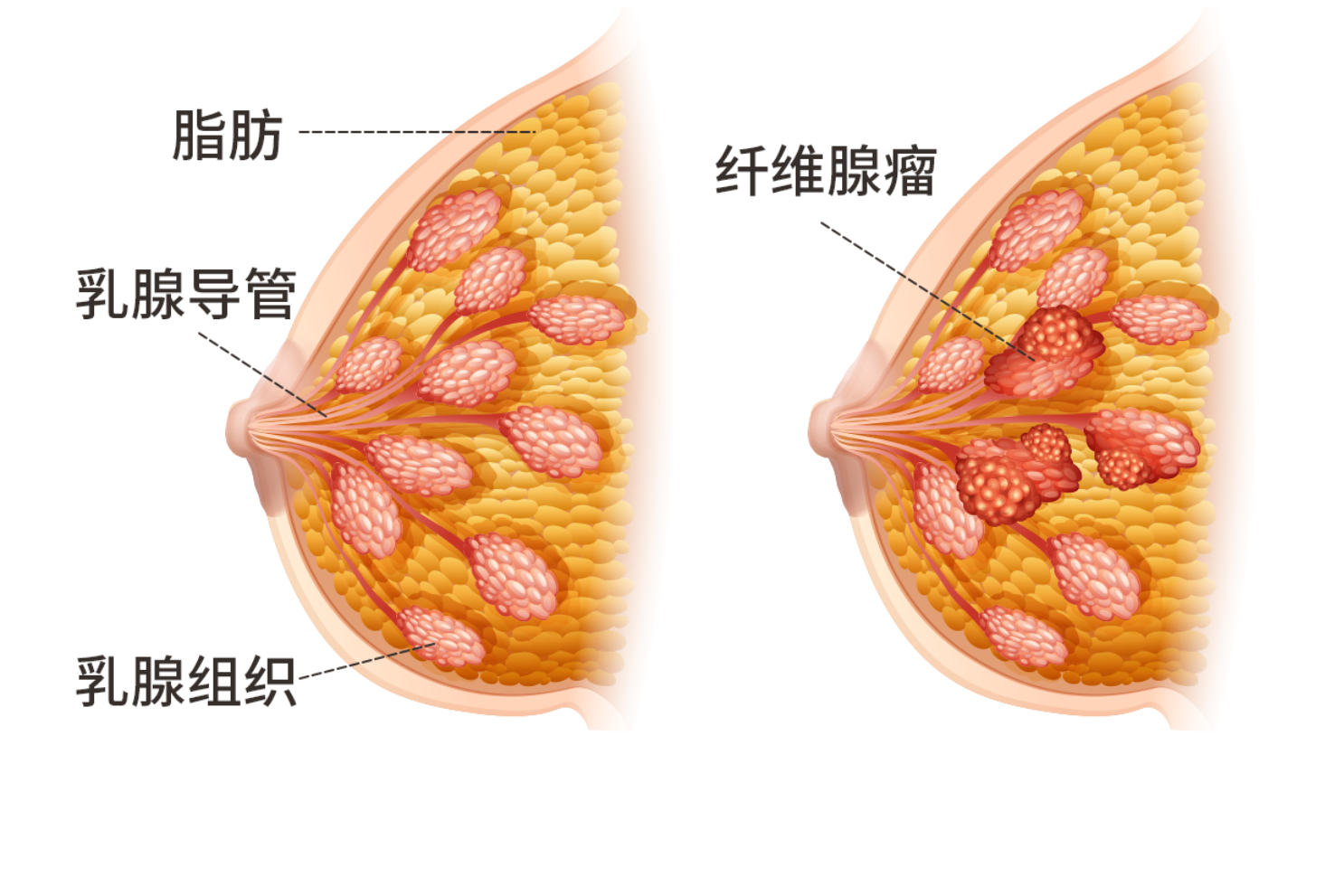 乳房有肿块严重吗?