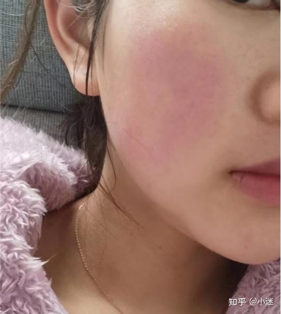 脸部总是泛红用什么护肤品比较好