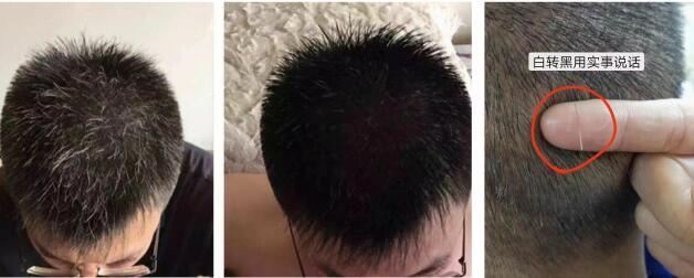 关于少白头养黑,分享根除方法。 - 知乎