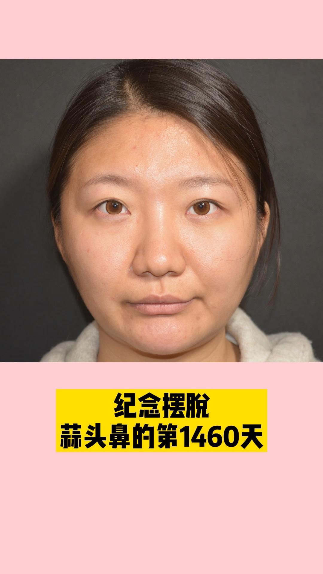 我这是蒜头鼻吗? - 知乎