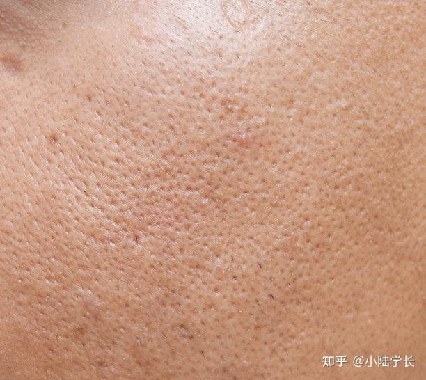 干货来啦不同类型的毛孔粗大改善方案不看后悔