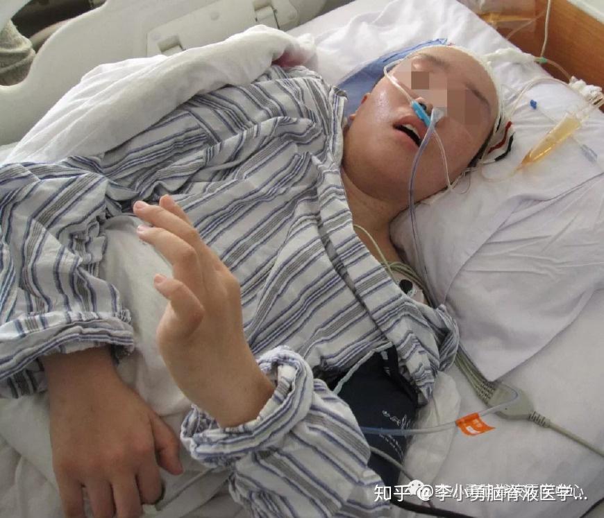 26岁剖腹产子应发感染致脑积水复发经李小勇治疗重回幸福生活