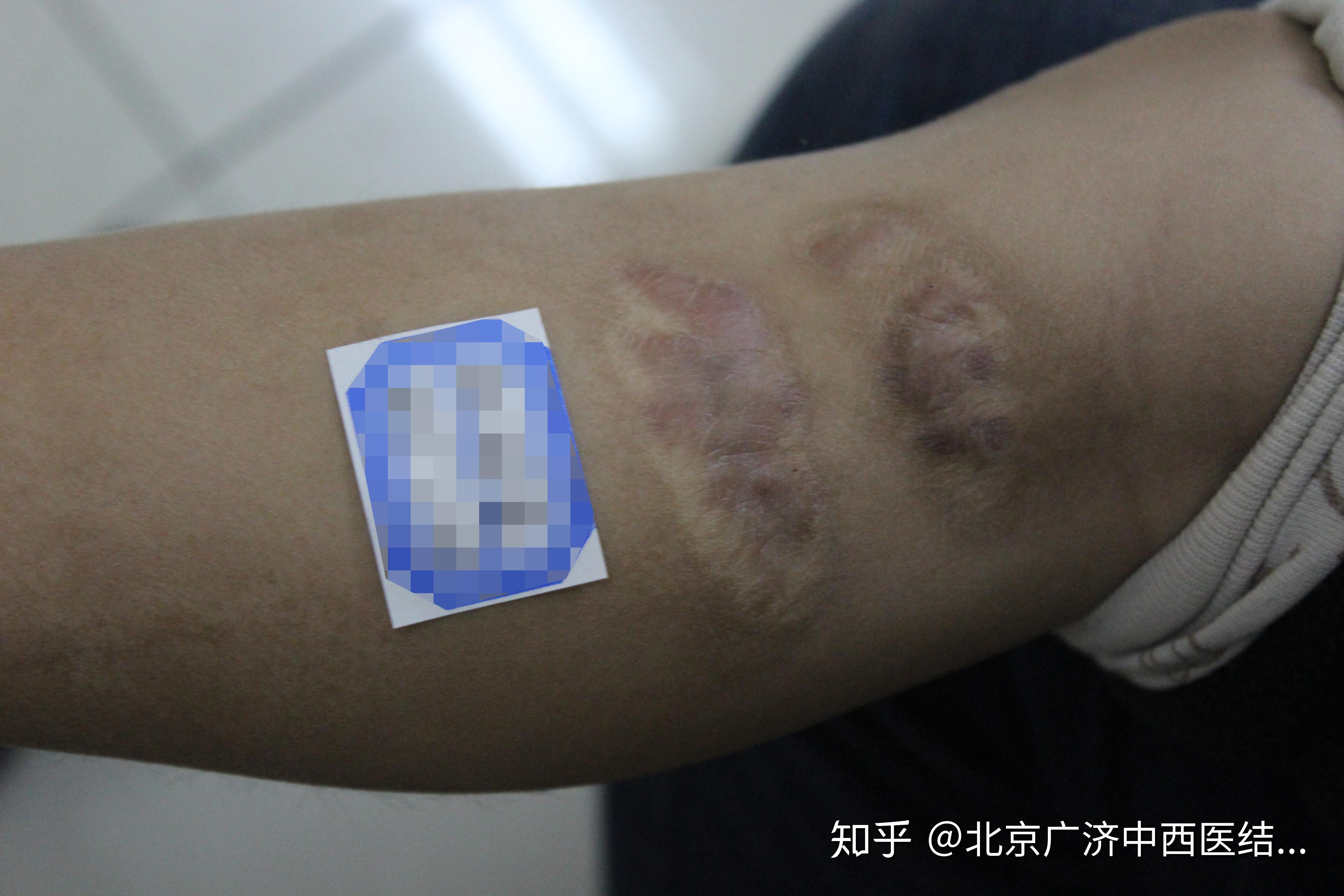 刘宝宝左手因热液烫伤导致的增生性疤痕治愈了_北京疤痕医院_瘢痕修复_疤痕治疗_北京疤康医院【官】