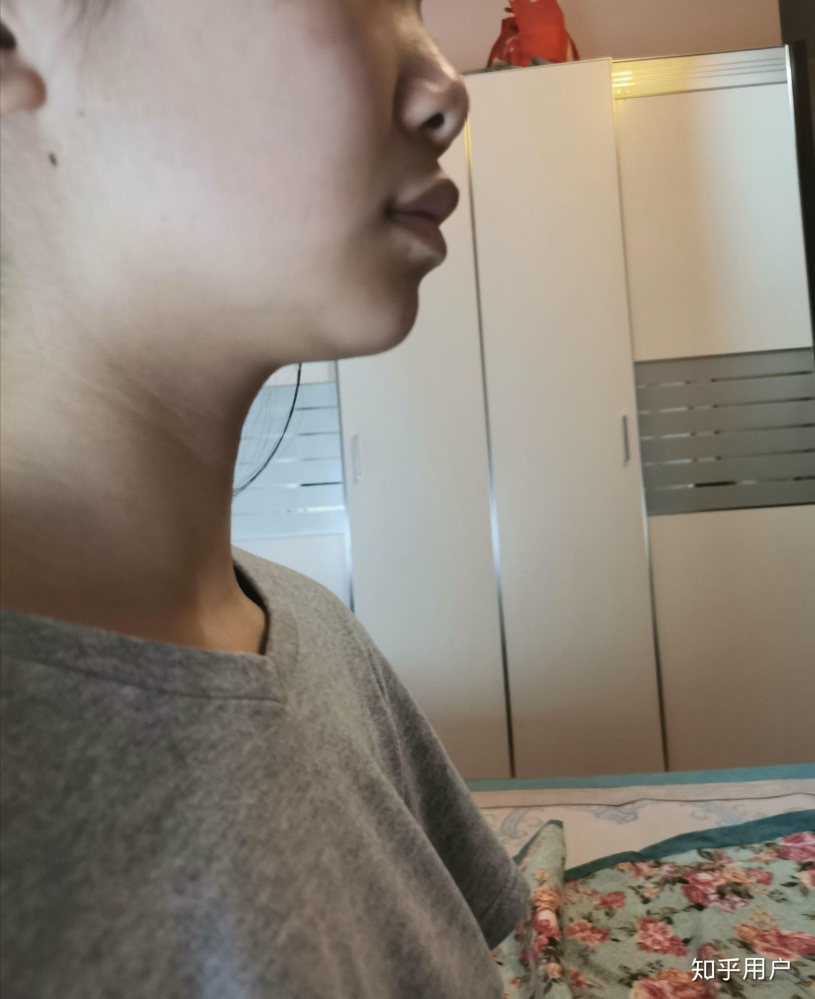 上嘴唇上翘上翻怎么办侧面看起来简直丑哭我