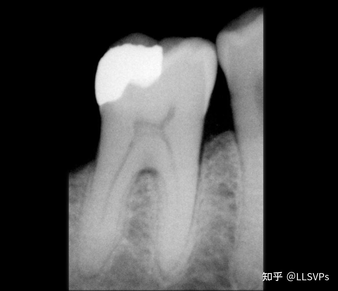 牙釉质(tooth enamel) - 知乎
