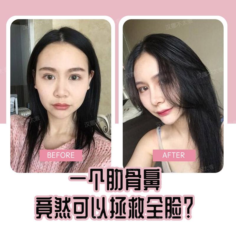 肋骨鼻综合一个肋骨鼻竟然可以拯救全脸 知乎 肋骨鼻综合一个肋骨鼻竟然可以拯救全脸 知乎