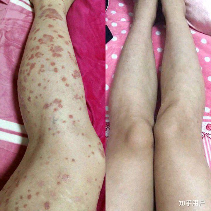 银屑病患者应该考研吗
