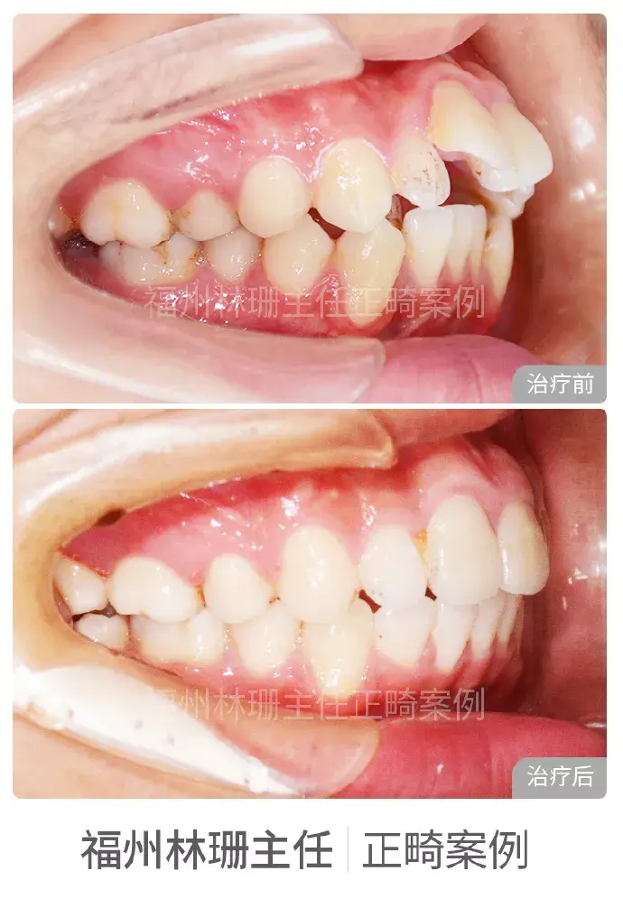 福州牙齒矯正林珊主任部分案例分享 | 原福建醫科大學附屬第一醫院