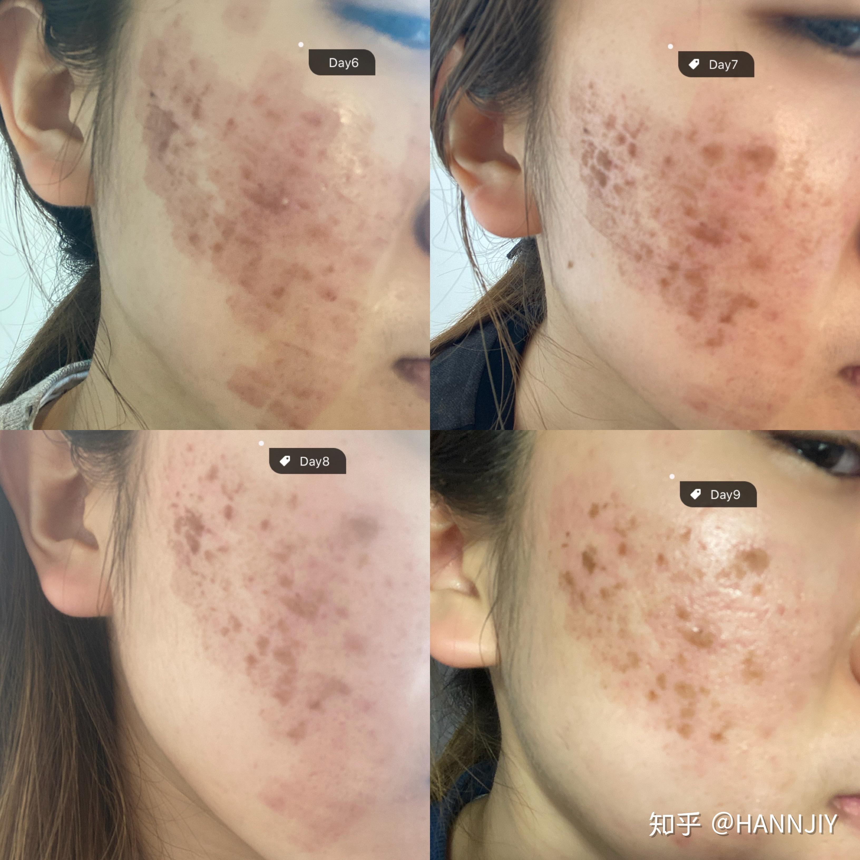 co2激光祛痘坑感受效果如何