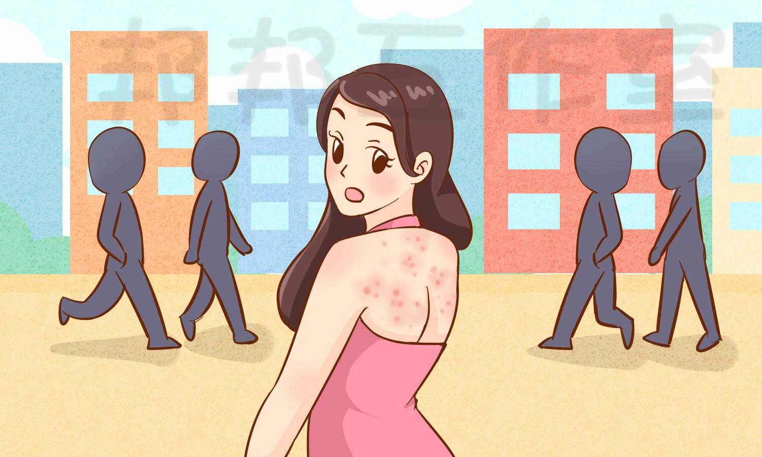 为什么有些人后背长痘痘是体质问题吗