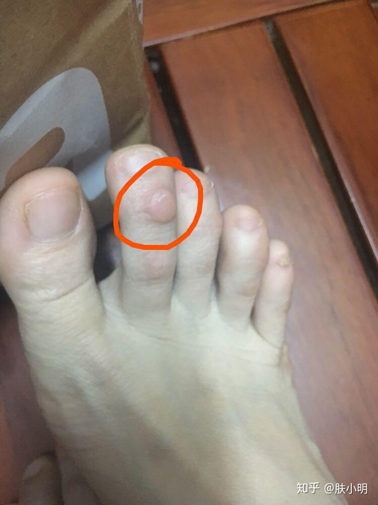 脚上被鞋子磨出茧要怎么办